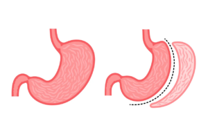 Tüp Mide (Sleeve Gastrektomi)