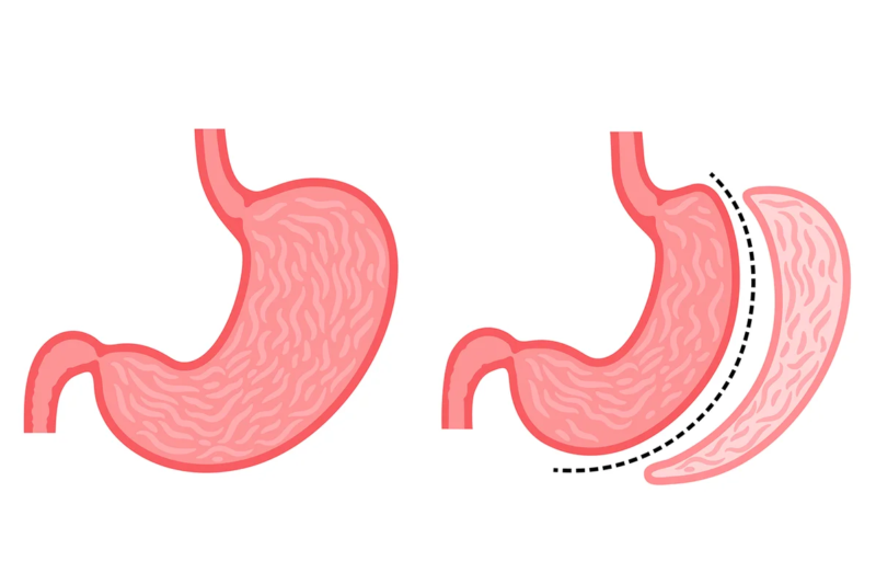 Tüp Mide (Sleeve Gastrektomi)